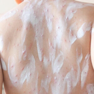 Atopic Dermatitis – Treatment Options That Can Be Tried at Home